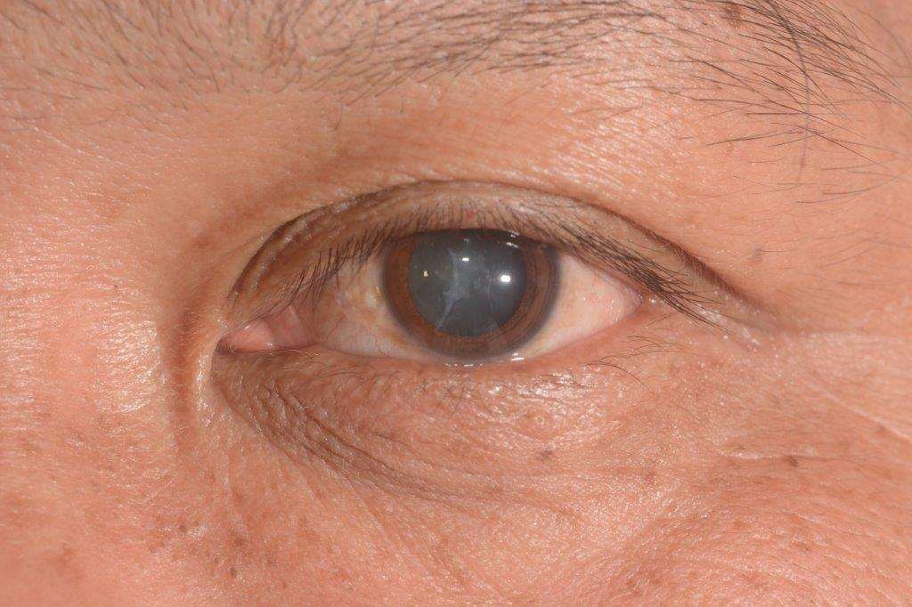 Cataract