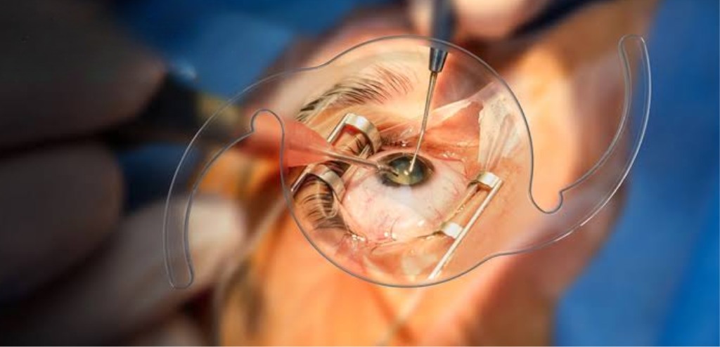 Advanced Cataract Surgery